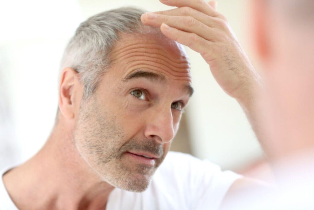 7 Common Signs of Receding Hairline